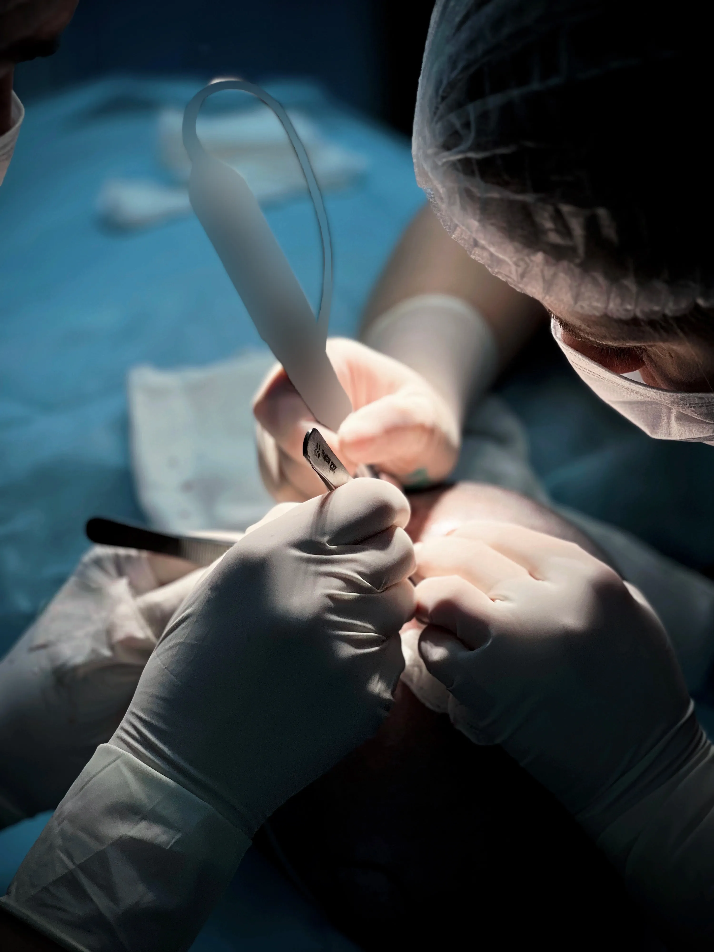 Метод FUE - этап 7