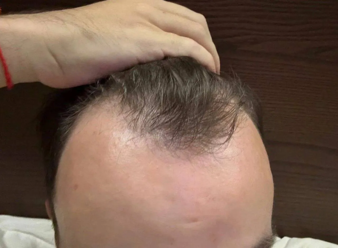 После пересадки волос