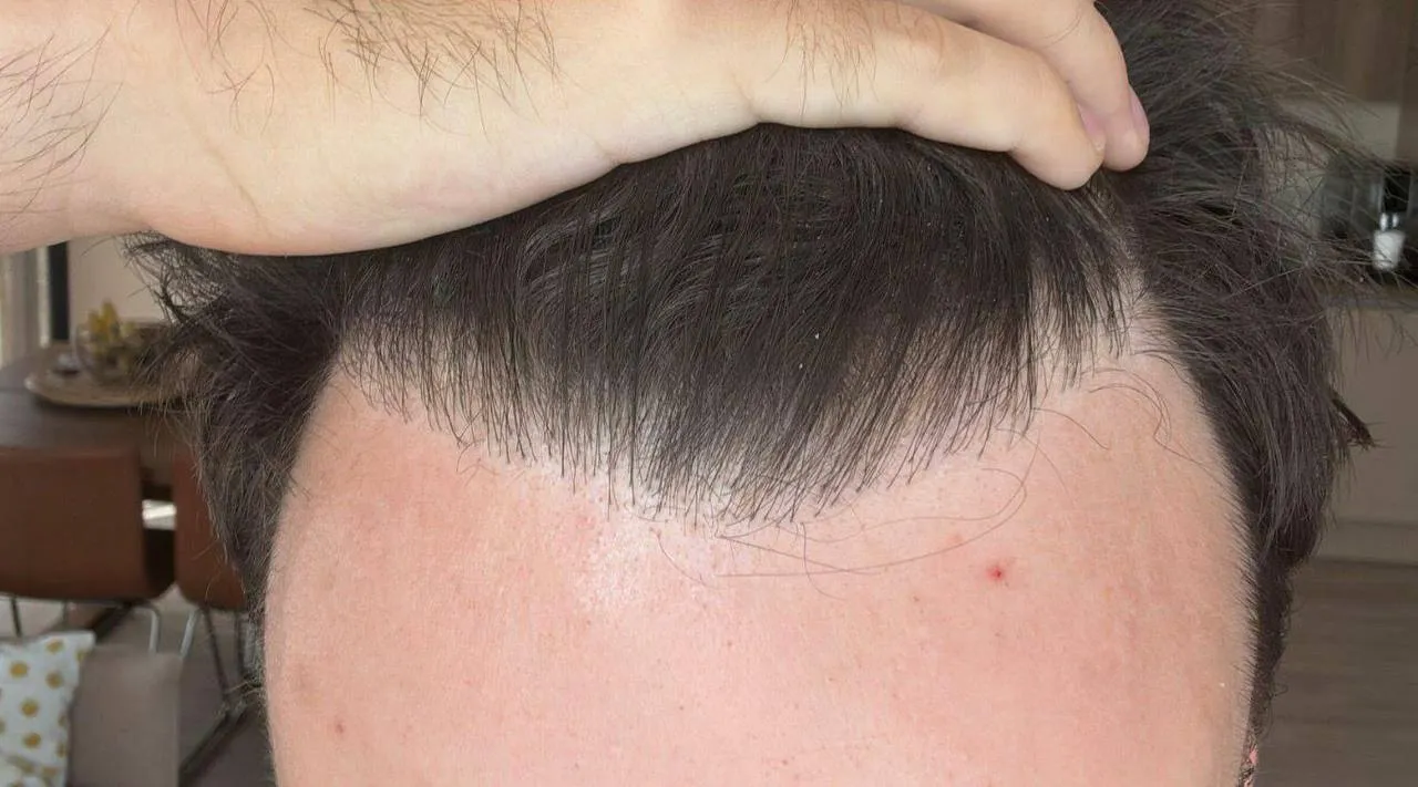 До пересадки волос