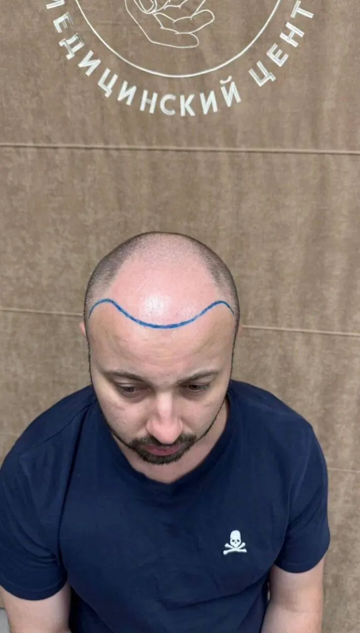 После пересадки волос