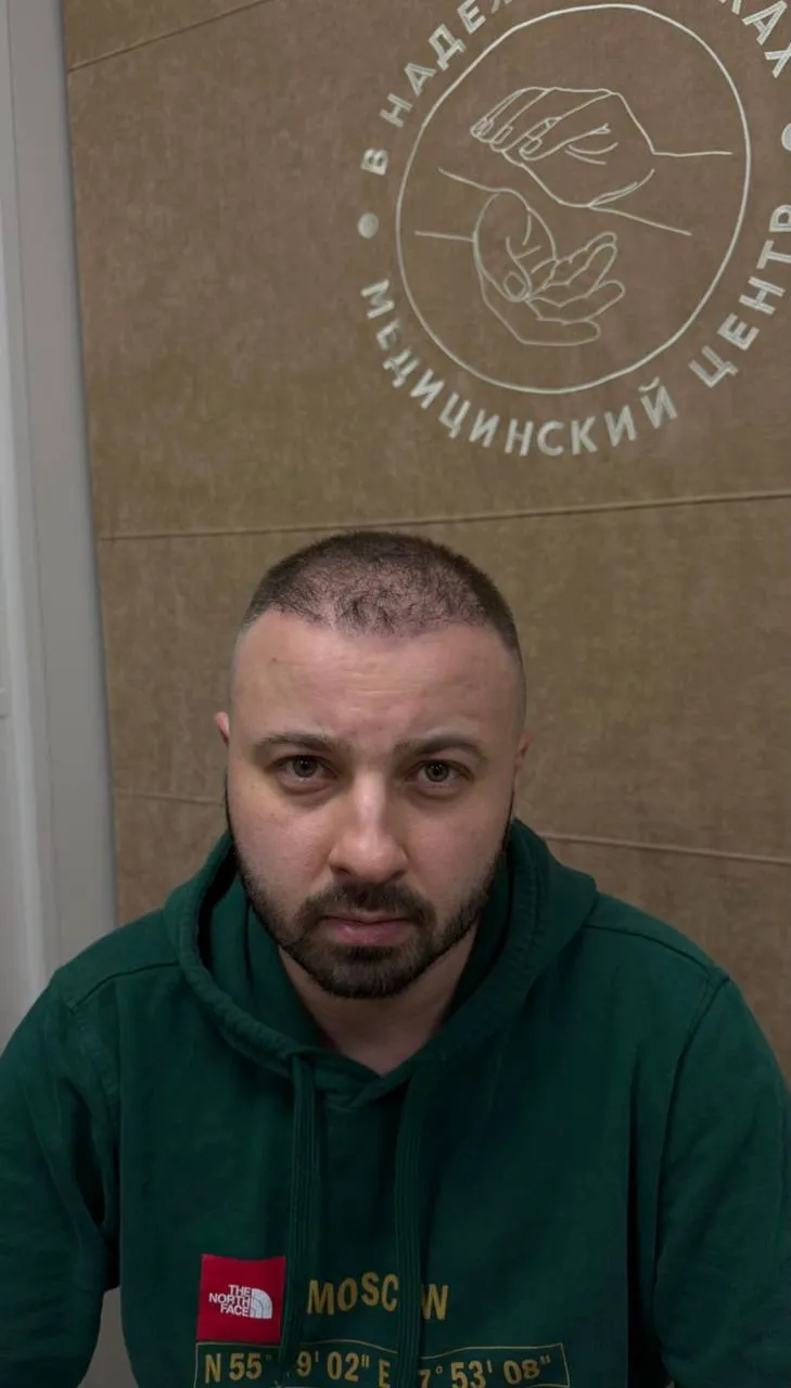 До пересадки волос