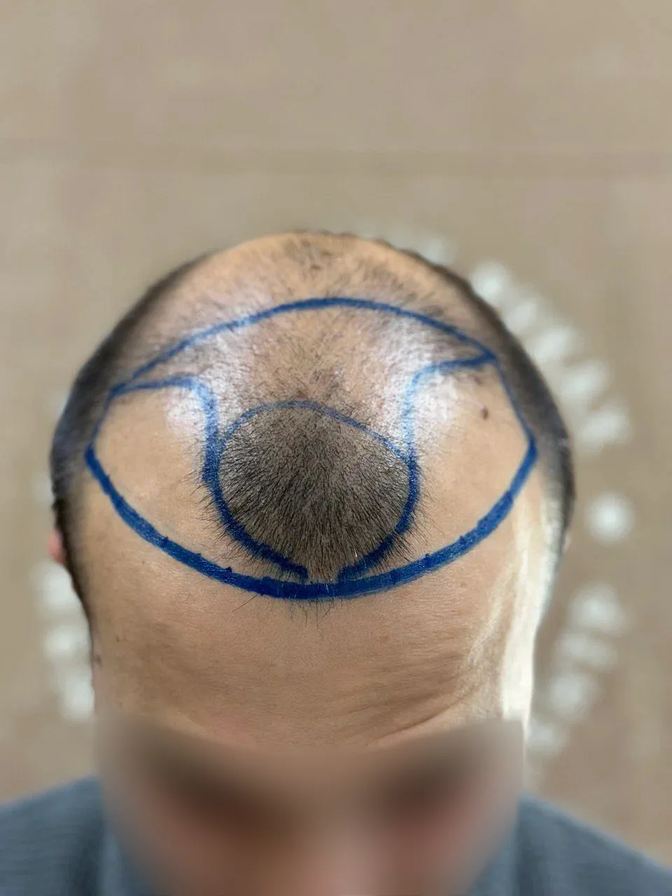 До пересадки волос