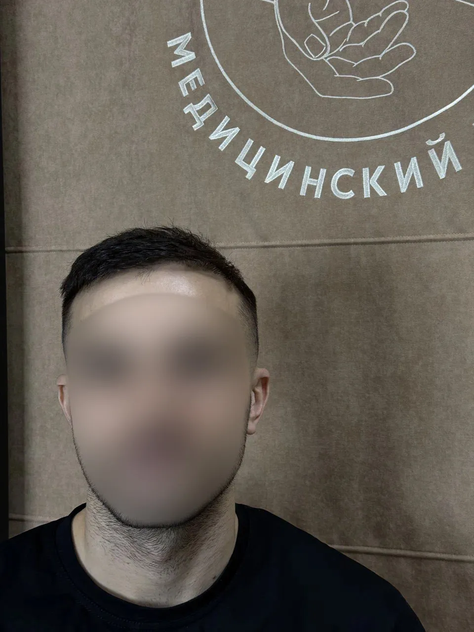 После пересадки волос