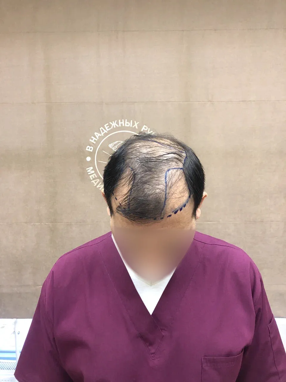 До пересадки волос