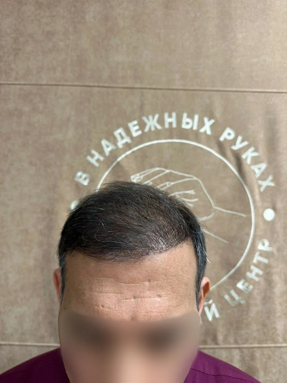 После пересадки волос