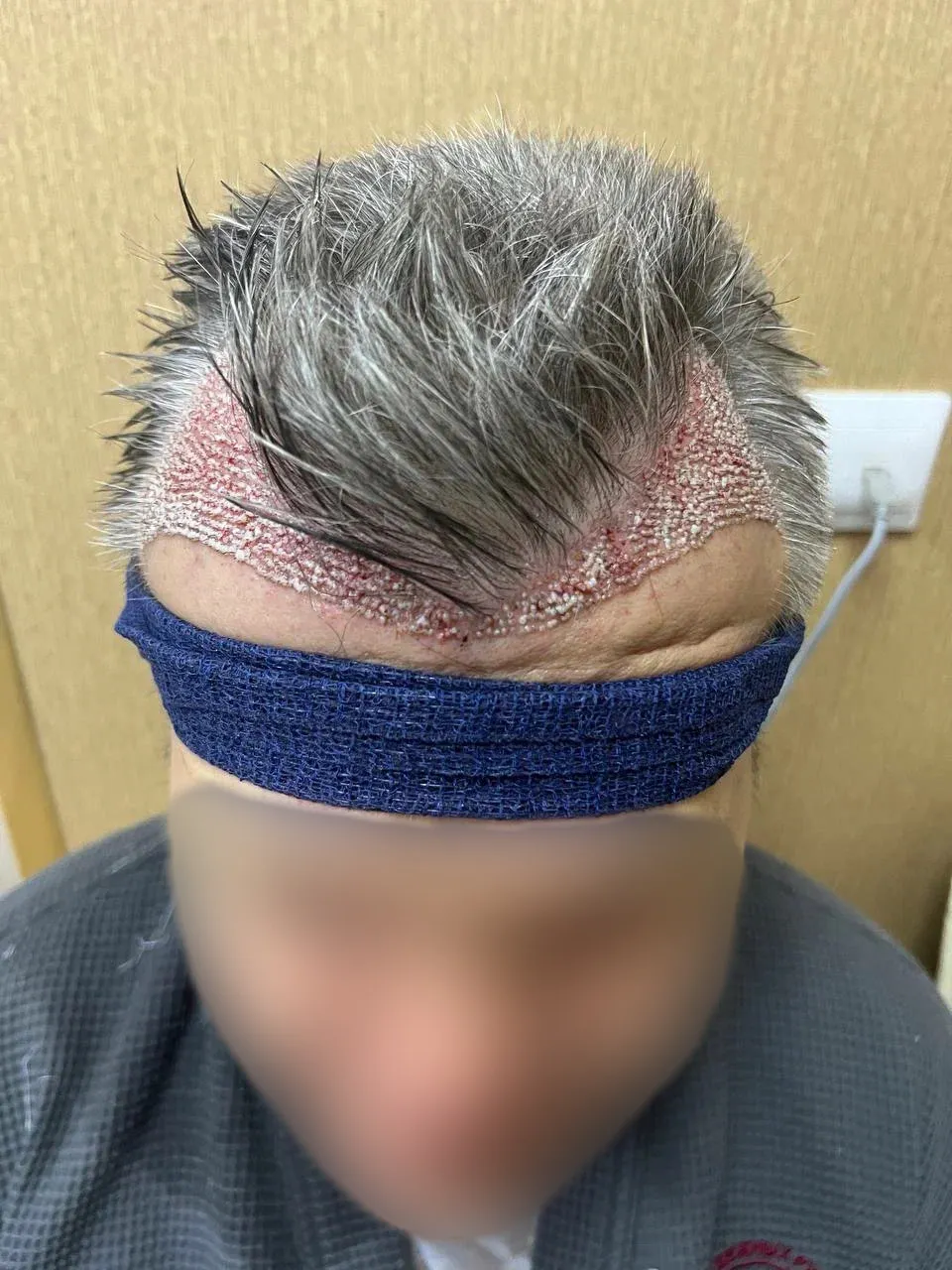 До пересадки волос