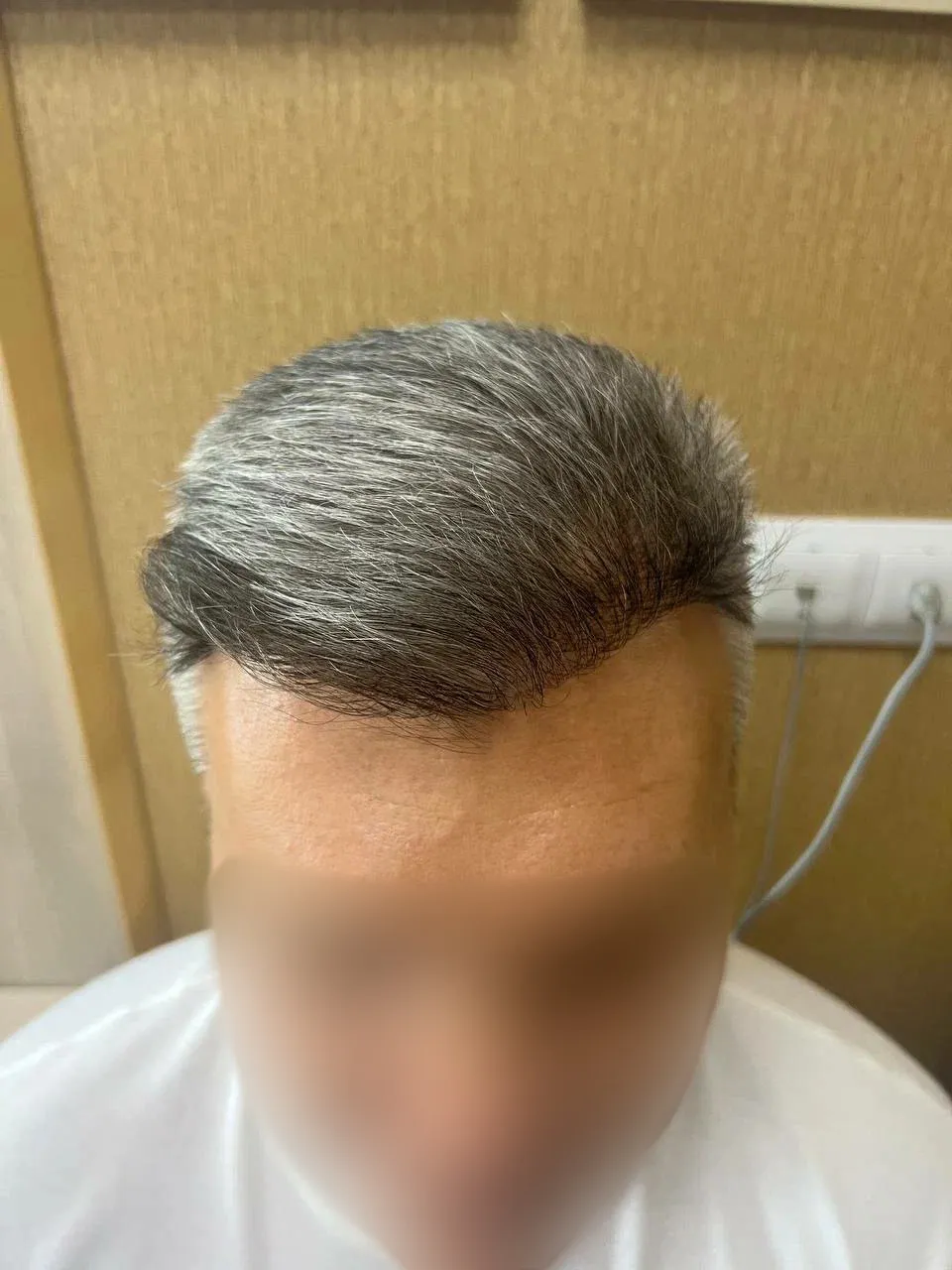 После пересадки волос