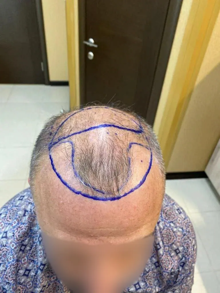 До пересадки волос