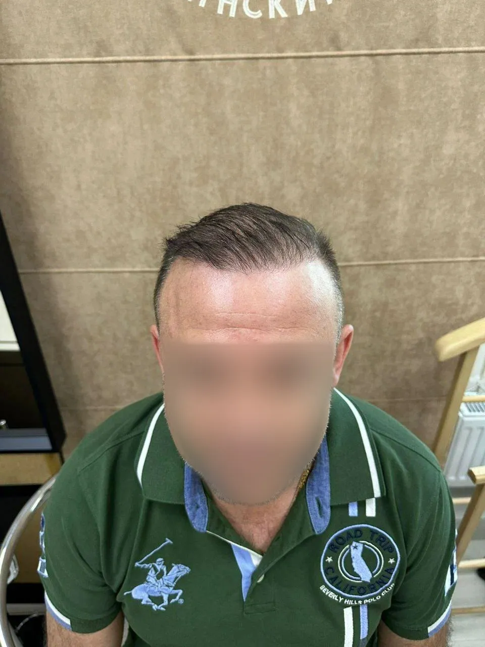 После пересадки волос