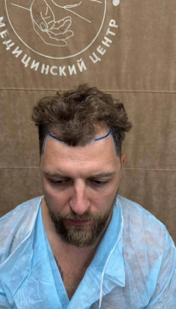 После пересадки волос