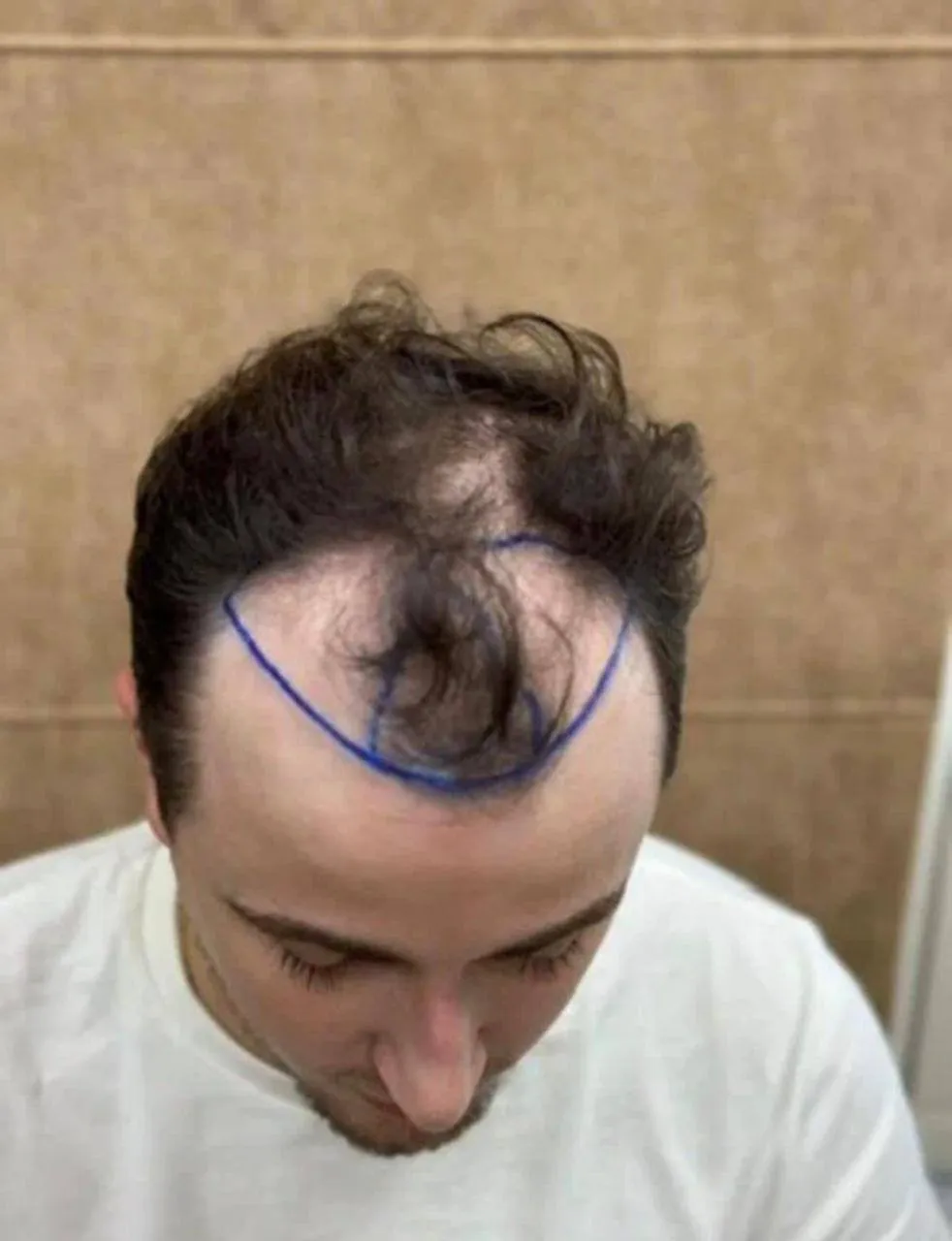 После пересадки волос