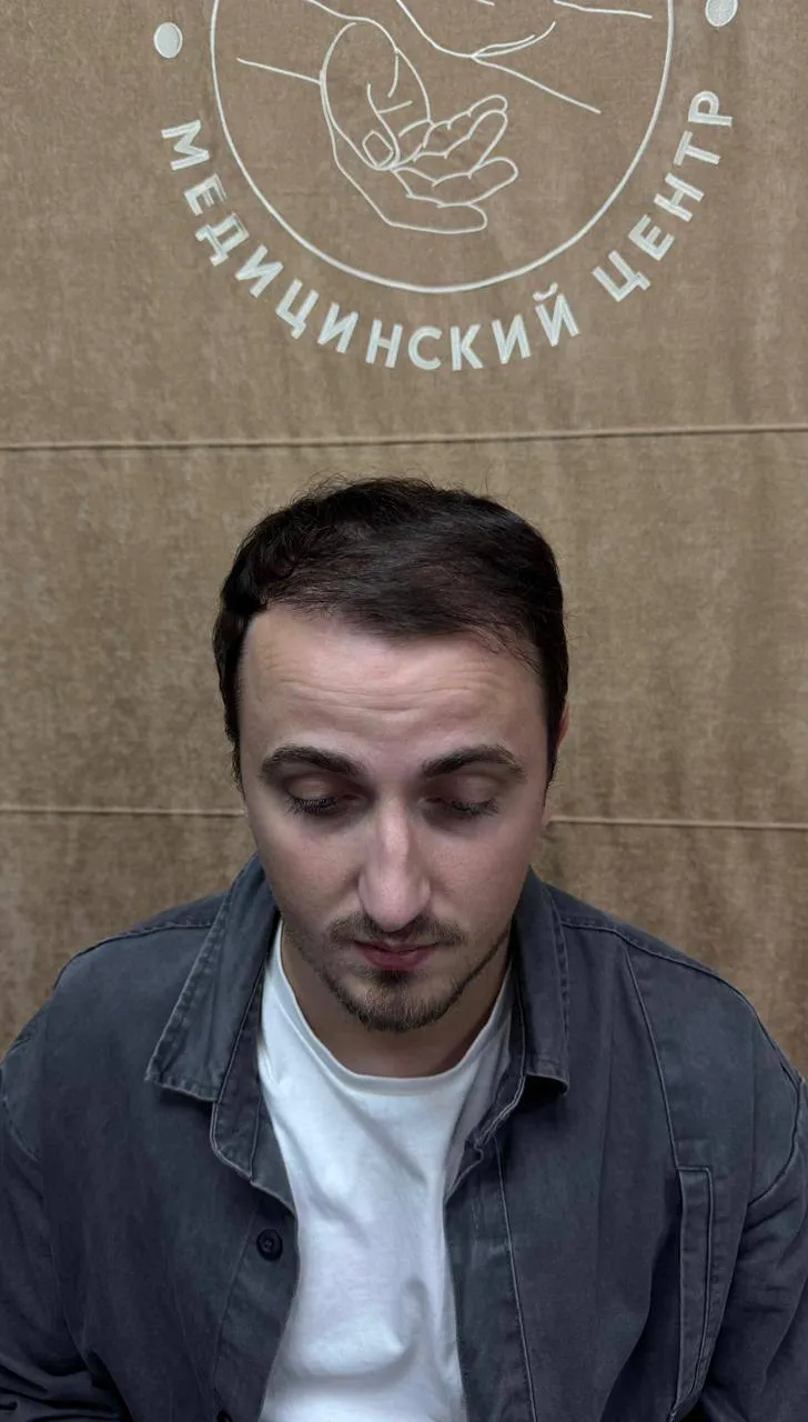 До пересадки волос