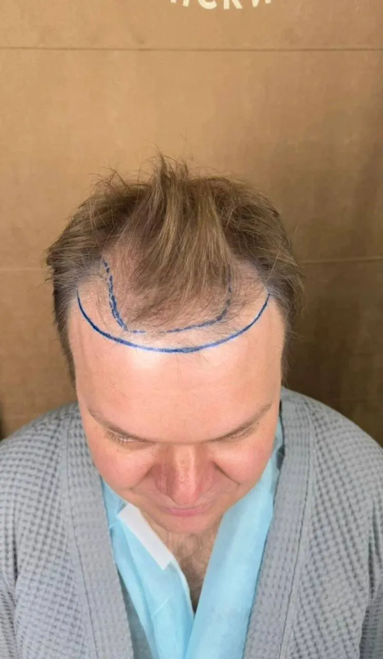 После пересадки волос