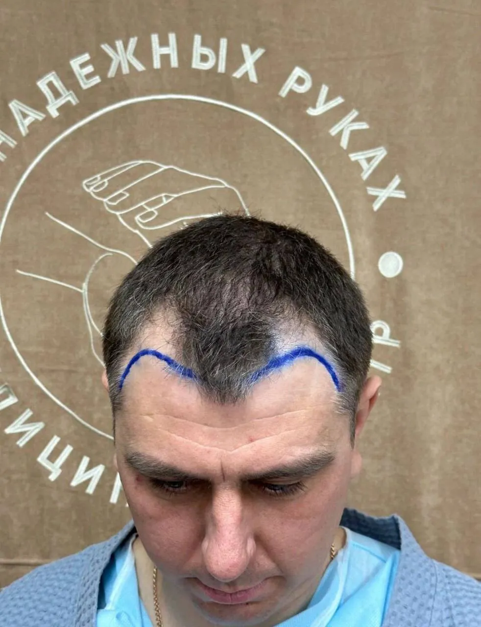 После пересадки волос