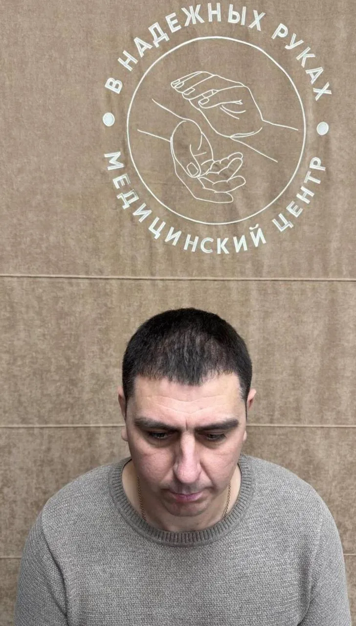 До пересадки волос